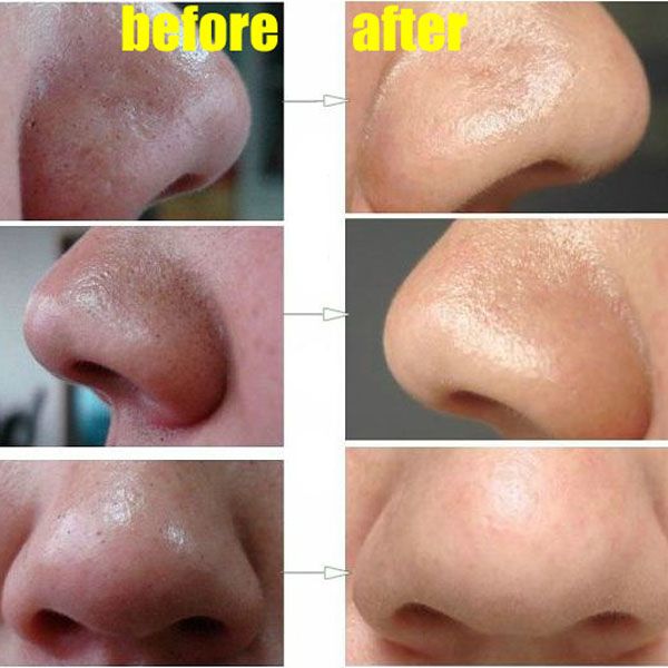 How To Easily Remove Deep Blackheads from Nose