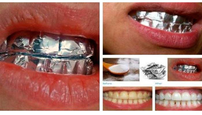 THIS Is What Happens When You Wrap Your Teeth In Aluminum 