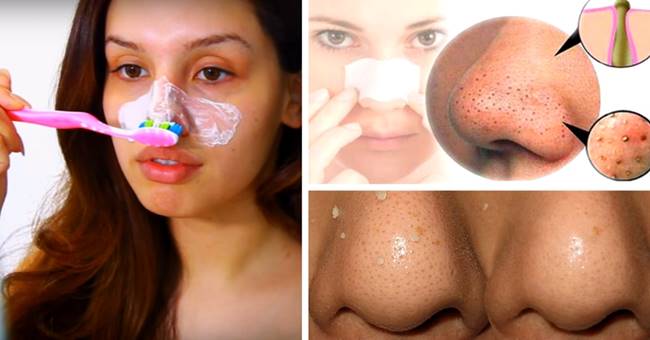 Creative Ideas - How To Remove Blackheads With A DIY Mask And A Toothbrush